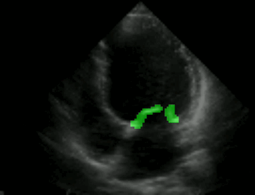 Mitral valve segmentation GIF